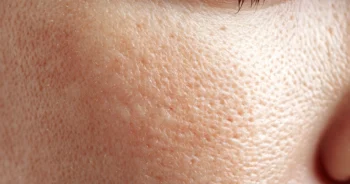 mujer con los poros abiertos