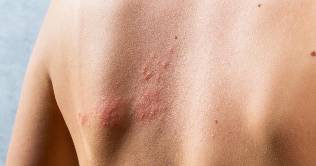 sarpullido en la espalda de una mujer