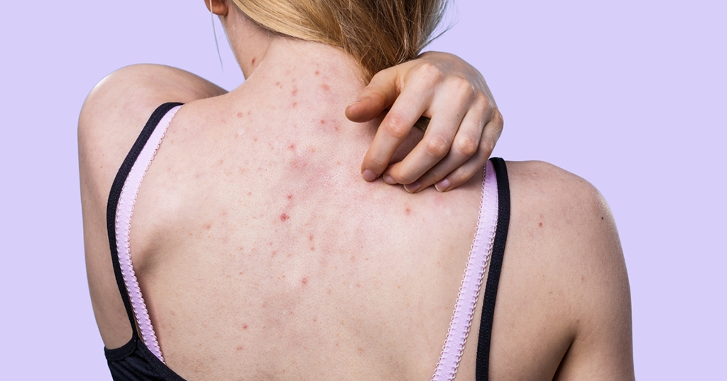 Cómo sacar los granos de la espalda