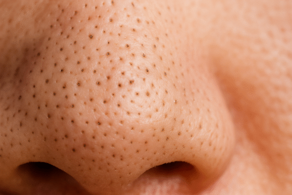 mujer con puntos negros en nariz