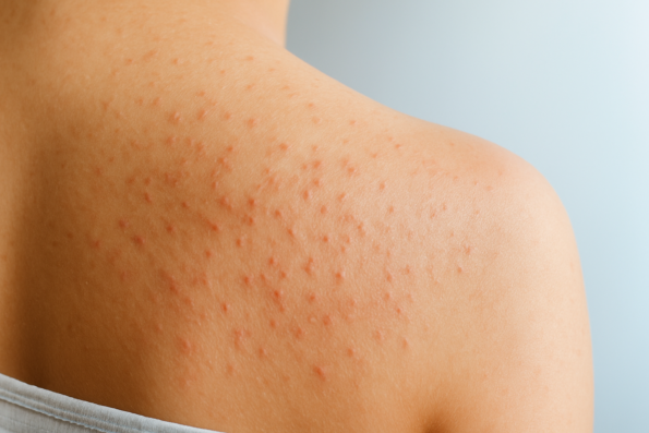 sarpullido en la espalda de una mujer